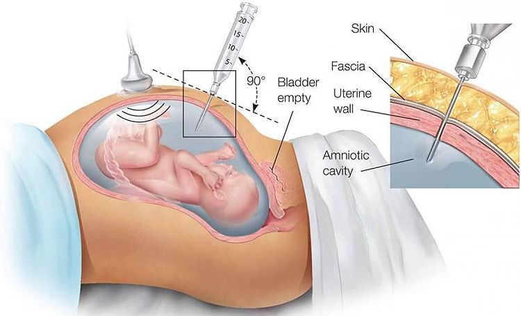 Amniocentesis