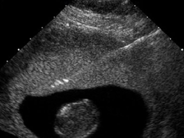 Chorionic villus sampling